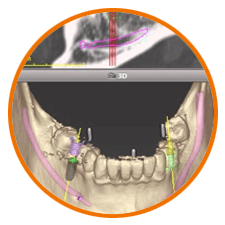 Dental Implant & Computer guided Implant treatment