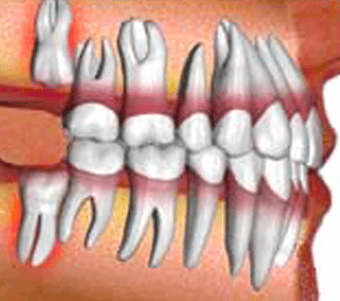 Dental Surgery (Wisdom tooth,Bone graft)