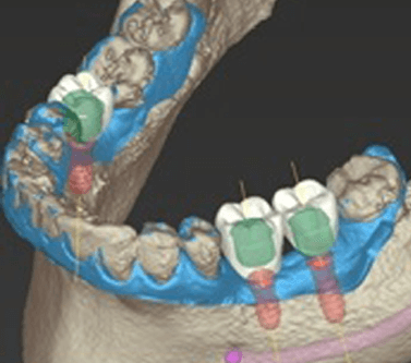 Dental implant